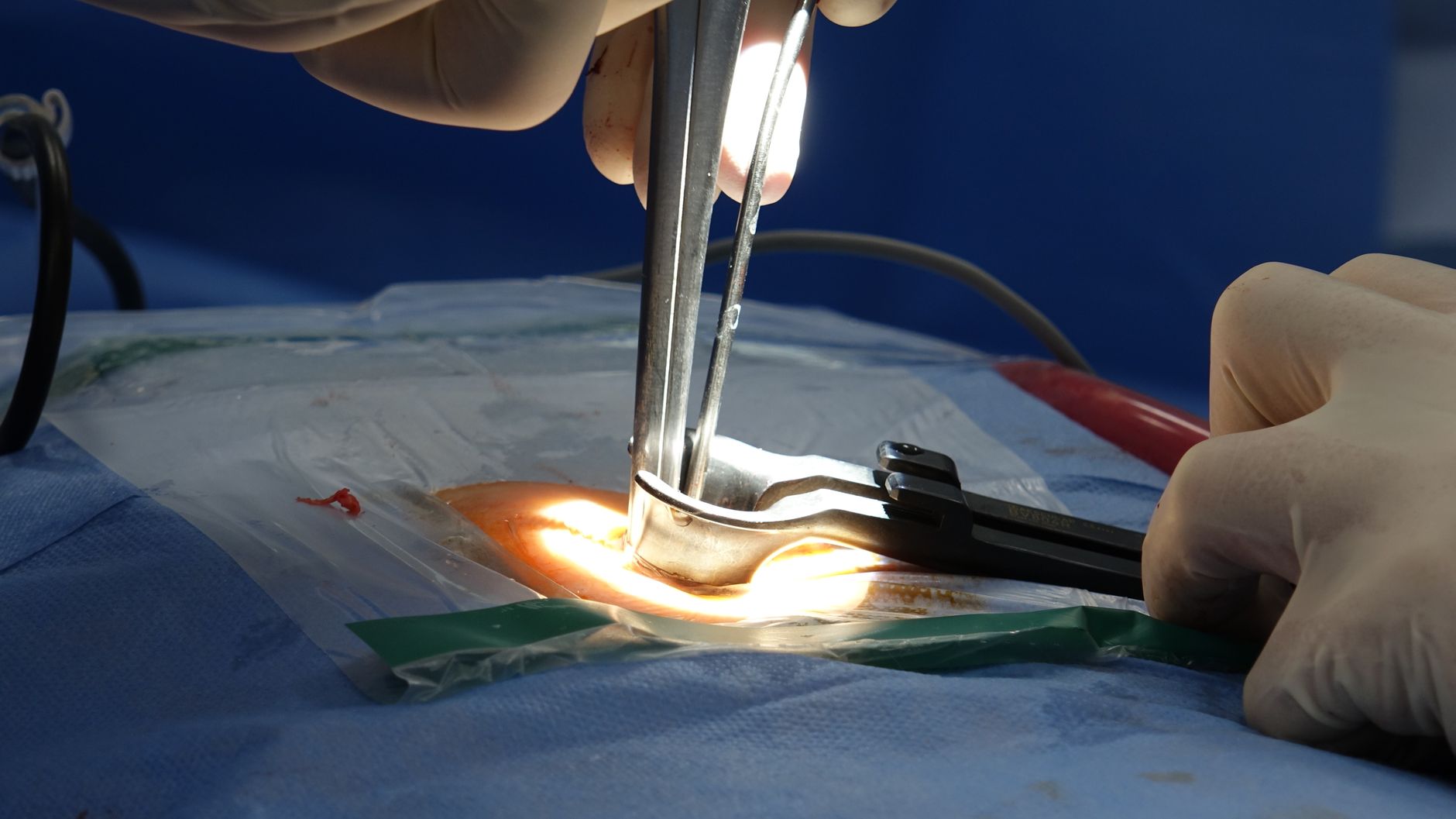 Sharat Saxena spine surgery: Is it the best choice for recovery?