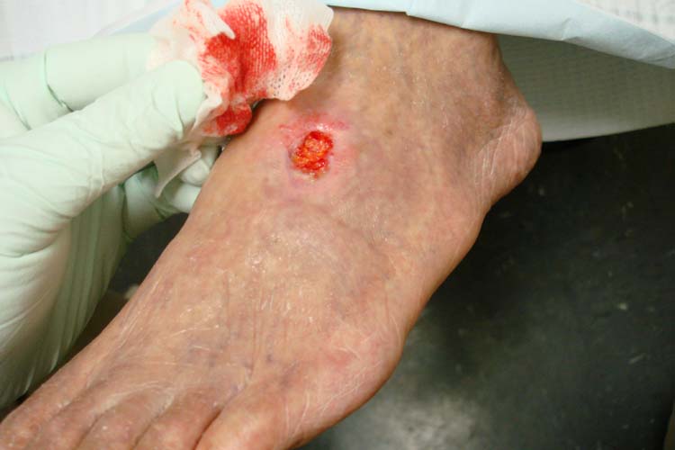 peripheral vascular disease